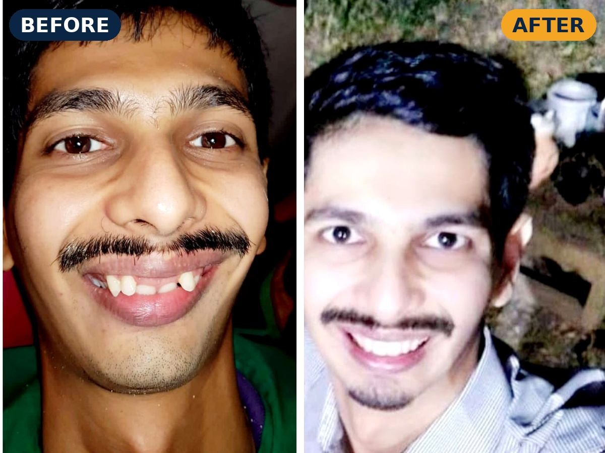 Before and after smile makeover of a young patient at Muskan Dental Clinic
