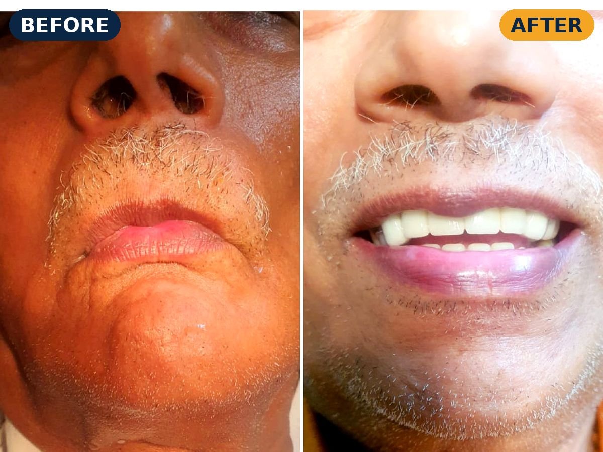 Before and after fixed teeth for a senior patient