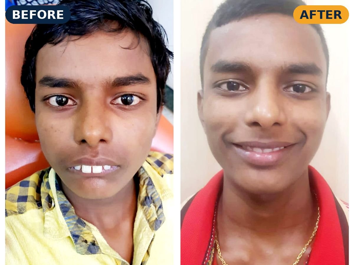 Before and after front-teeth correction of a young patient