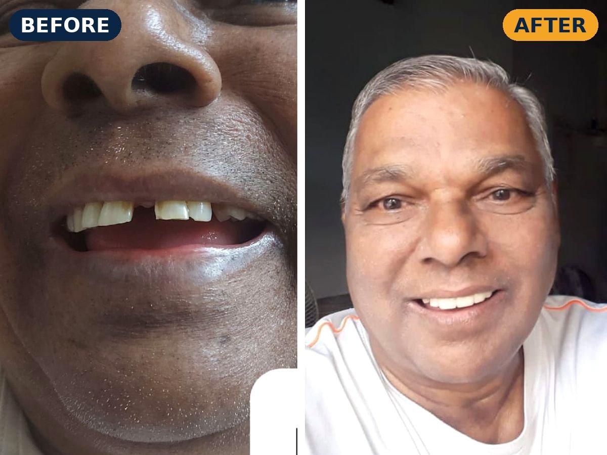 Before and after implant teeth of a senior patient